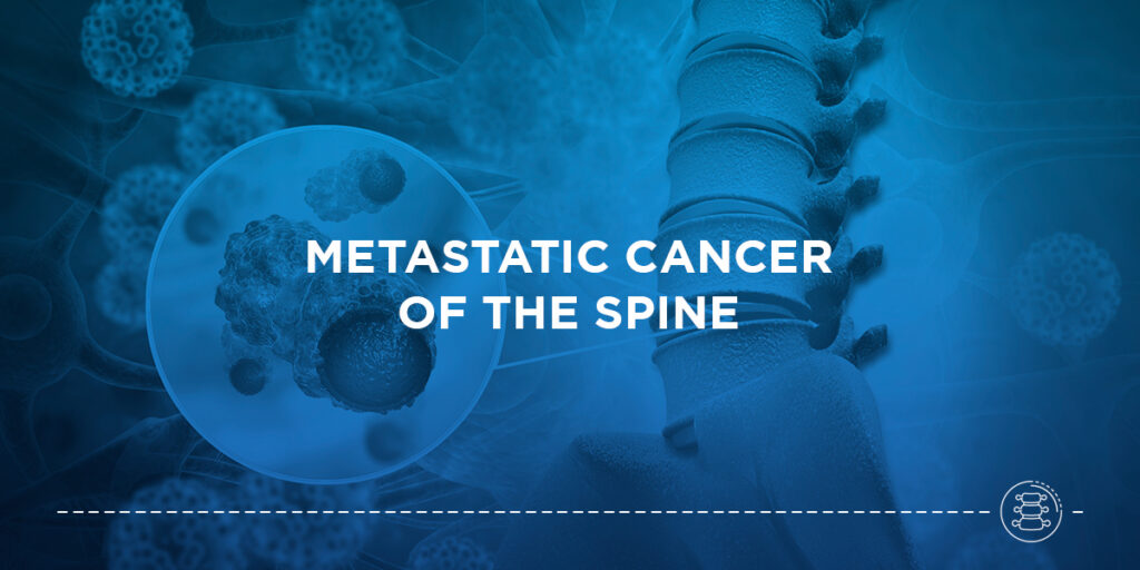 Metastatic Cancer of the Spine NYSI