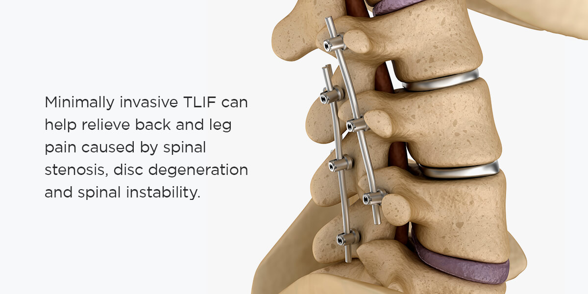 What is the recovery time for TLIF surgery?